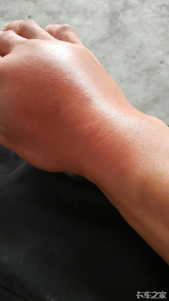 躺着都能中招卡友们你们被蜜蜂蛰了有啥感觉