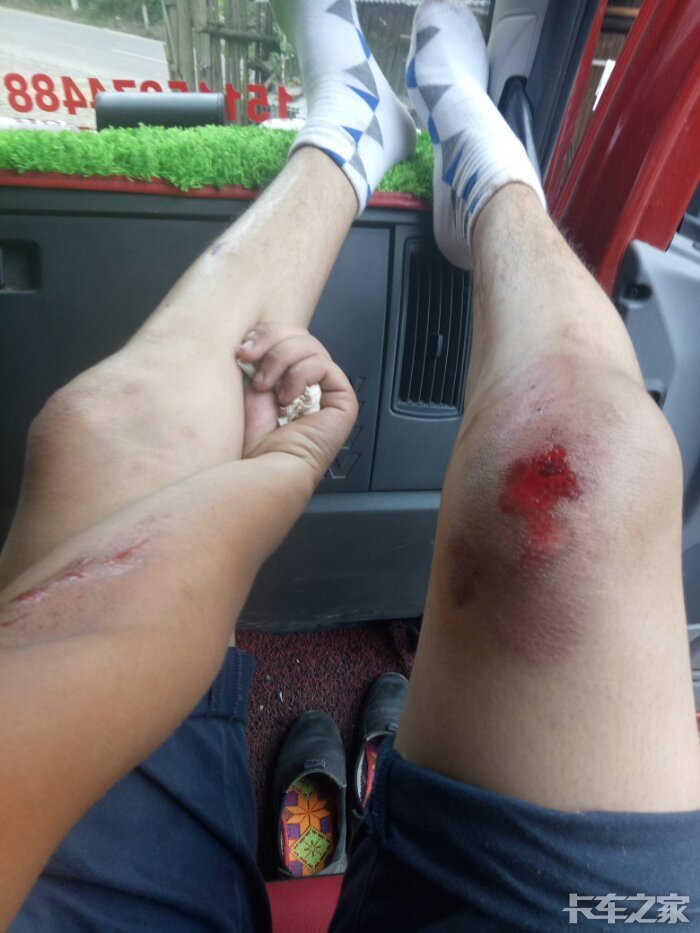 倒霉昨天骑摩托车回家摔翻了