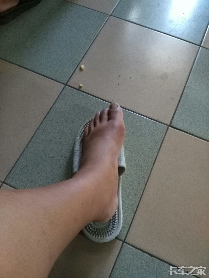 万能的卡友们昨天脚肿了到医院一看说是痛风疼的钻心踩不