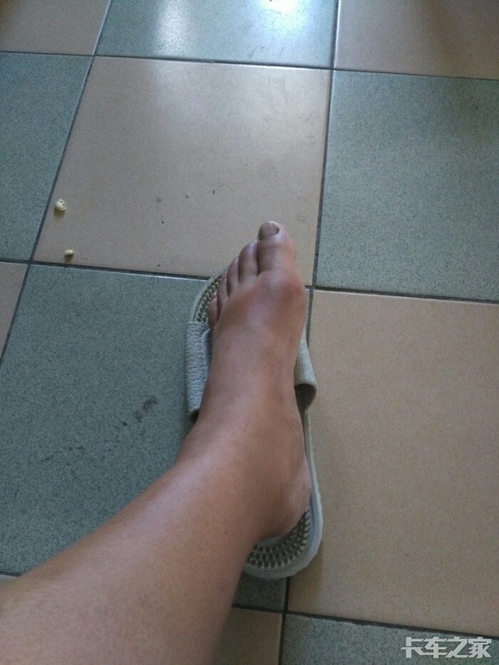 万能的卡友们昨天脚肿了到医院一看说是痛风疼的钻心踩不