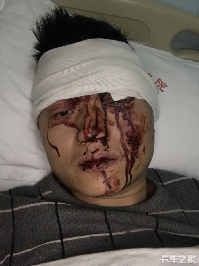 我在贵州黔东南被恶意攻击用凳子砸伤头部