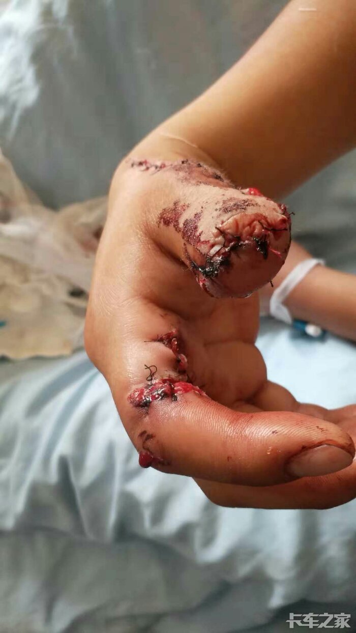 在刚厂里装钢筋把手指绞断了