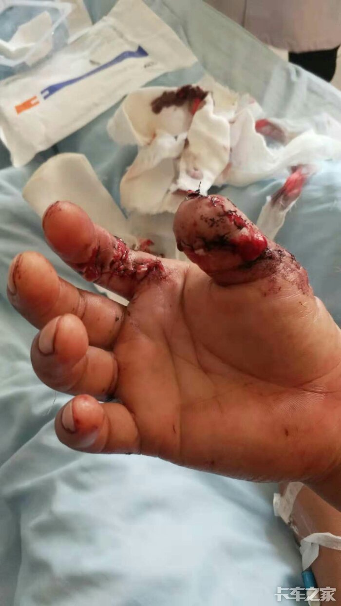在刚厂里装钢筋把手指绞断了
