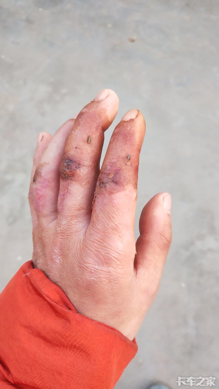 手指关节受伤了能增驾吗